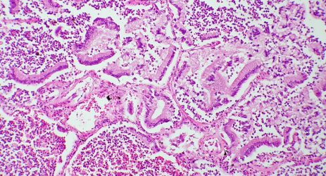 tumore pancreas